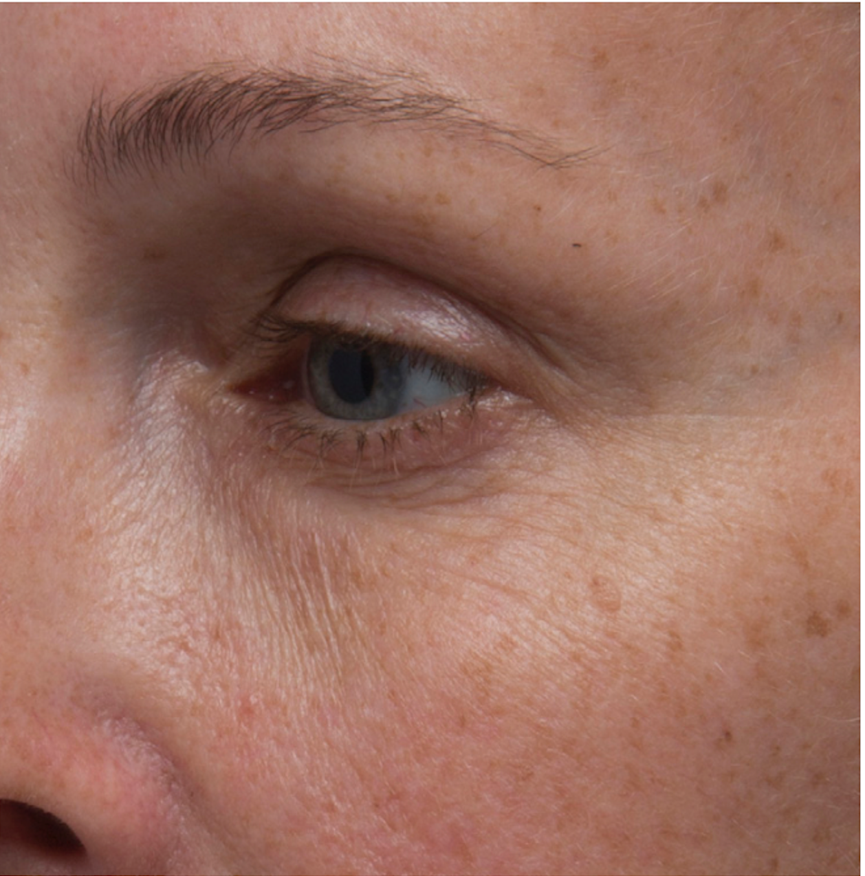 Before Photo - Medical Grade Skincare