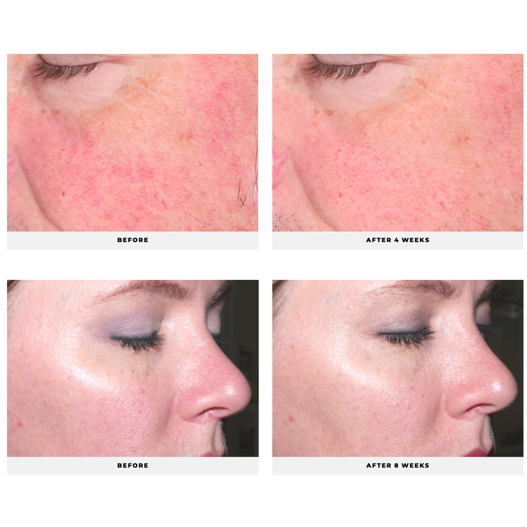 before and after image of face showing improved results